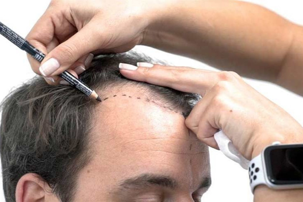 En iyi saç ekim merkezi hangisi? Saç ektirme fiyatları neler?